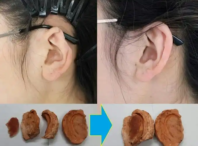 耳朵缺损怎么办? - 好大夫在线