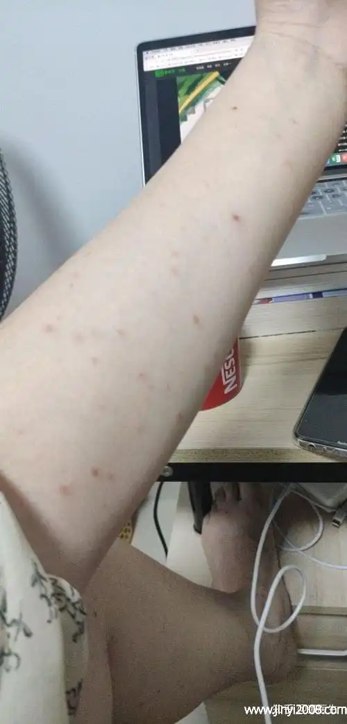 虾可以多吃吗吃虾会过敏吗