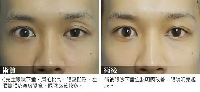 台中眼袋 -- 眼睑下垂