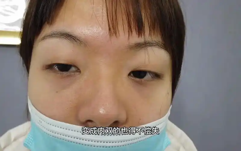 眼睛近视三百度数有轻微大小眼双眼皮喜欢自然些的风格