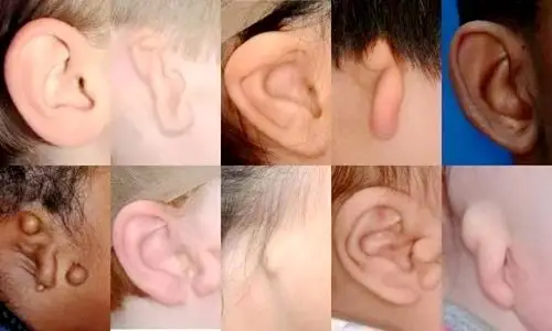 写给全国爱耳日:宝宝"先天性小耳畸形"不是末日,家长要知道怎么治疗!
