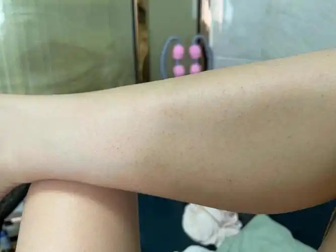 身子长小红点用这款药膏绝了