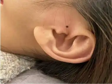 交界痣耳朵前面长了一颗黑痣图