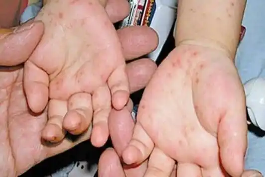 从小儿手足口病图片 看手足口病的初期症状及表现