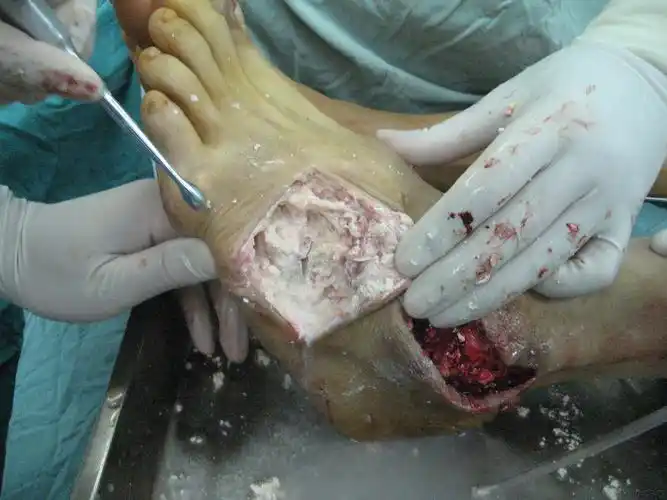 术中用刮匙刮除残余尿酸盐结晶并盐水冲洗