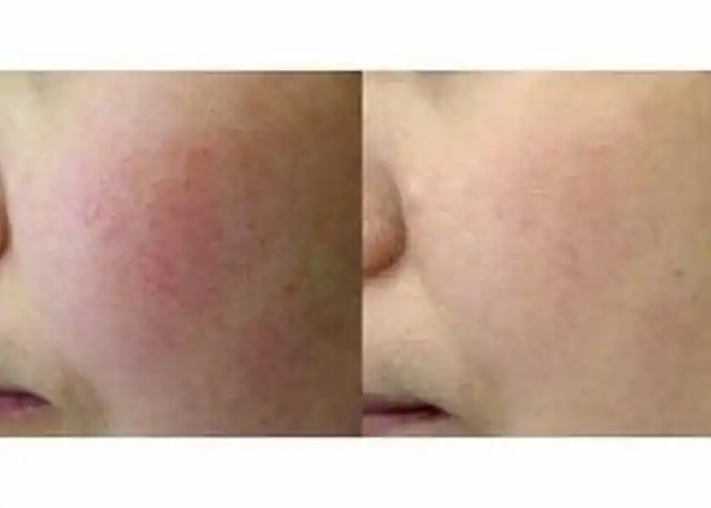 红血丝的病因是什么