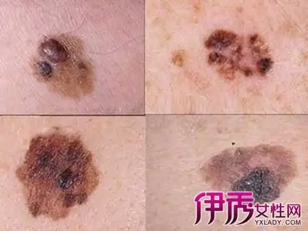 【图】早期皮肤癌能治愈吗 教你正确有效的处理方法