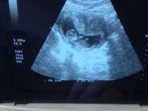 2015-05-12 20:10    浏览  33333  满意回答 孕四月胎儿性别形成