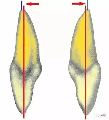 一颗牙的解剖上颌中切牙解剖形态特征