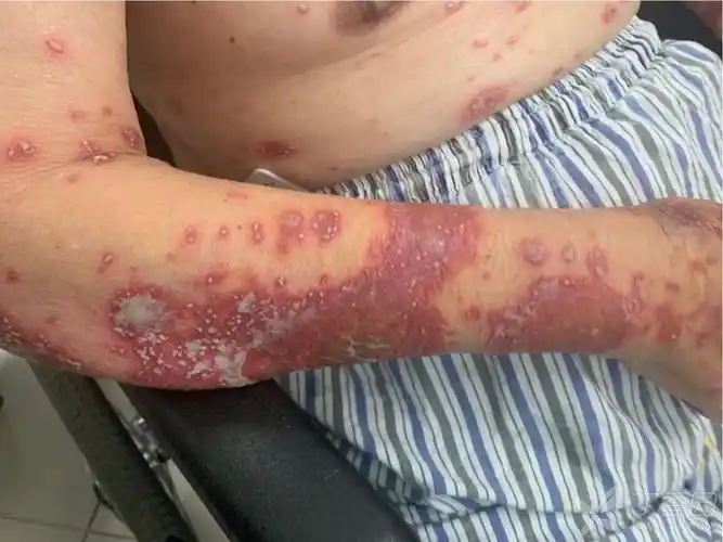背部大片红斑,脓疱,部分融合成脓湖,部分皮疹呈环形,褶皱部位脓疱环状