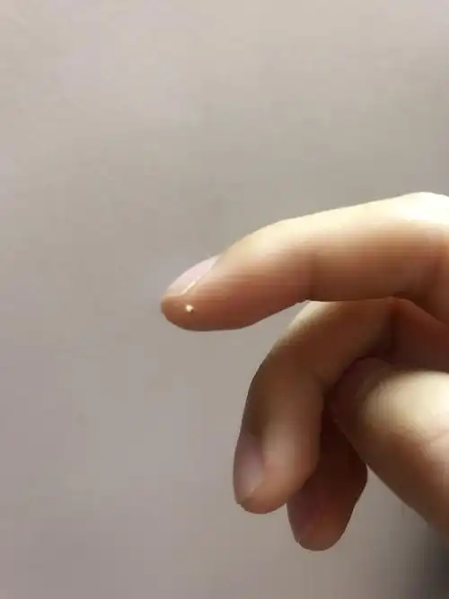 最近突然冒出一颗脂肪粒 连续3天徒手挤,抠都弄不出来