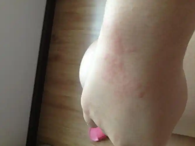 【图】从前几天开始每晚腿上都会长一串一串的红包,有点像刚被蚊子咬