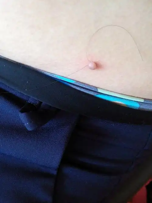 大家好,我从小腹部这块就有个小肉球,没当回事,今年