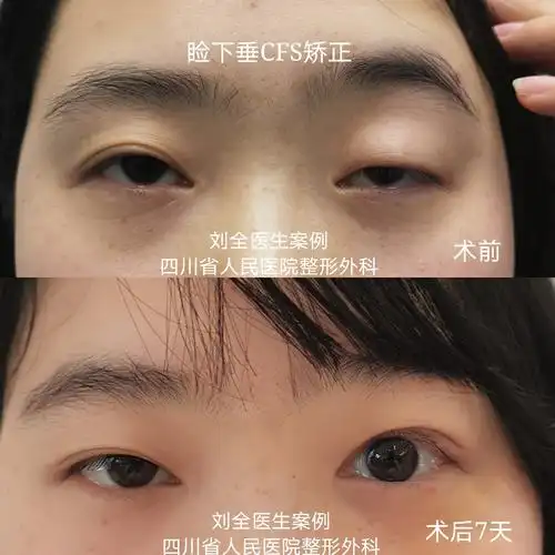 cfs～上睑下垂,用案例说话 - 好大夫在线
