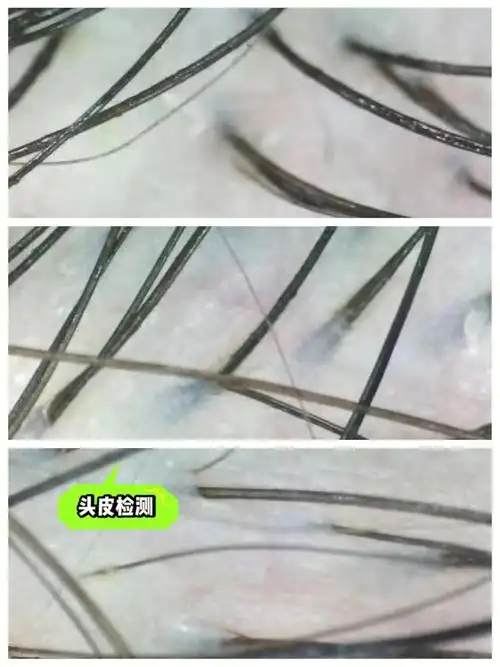 头皮护理之头皮刷酸轻松告别头屑头油头痒