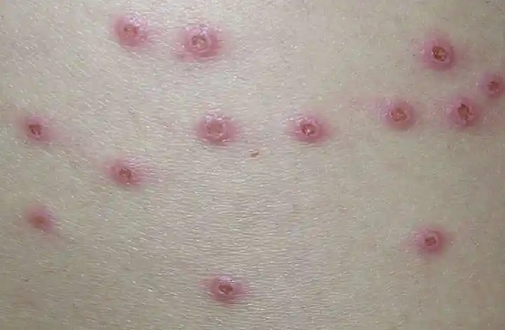 中日友好医院尤立平主任医师谈---成人水痘 - 好大夫在线