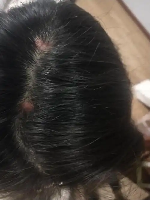 半年多了,头皮长的这是毛囊炎吗?