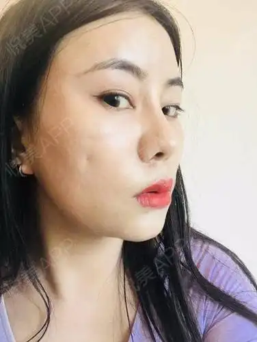 自体脂肪填泪沟术后15天_自体脂肪面部填充术后15天_面部填充术后15天