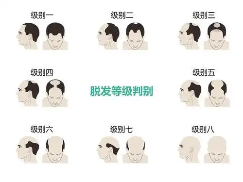 脱发等级