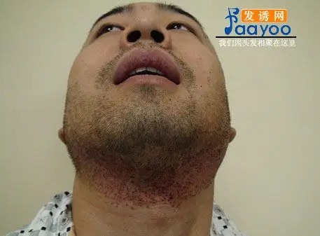 我的无痕植发无痕胡须植发经历