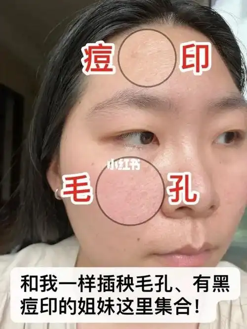 总结出来毛孔粗大的原因!姐妹们都快来抄作业!