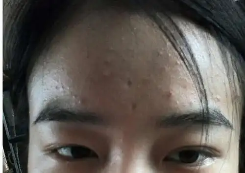 油性皮肤痘痘肌加闭合性粉刺的姑娘速戳此贴~福利来了