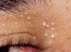 粟粒样丘疹图集