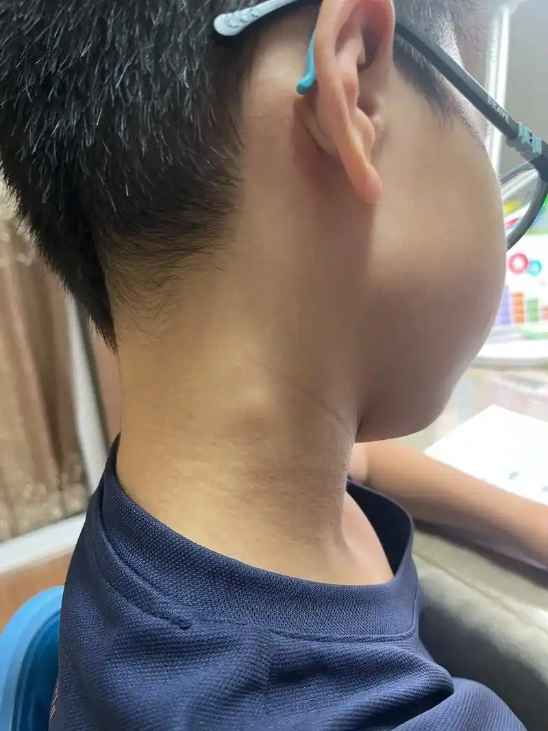求助抖音的朋友 孩子今年1月咳嗽一个月后 脖子的淋巴突然变大