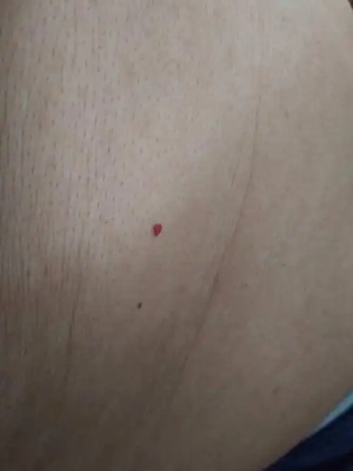 身上长红痣了慢慢会变黑 好几颗 咋办.