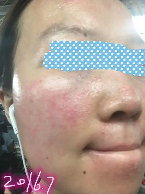 跪求:面部脂溢性皮炎让我生无可恋 - 知乎