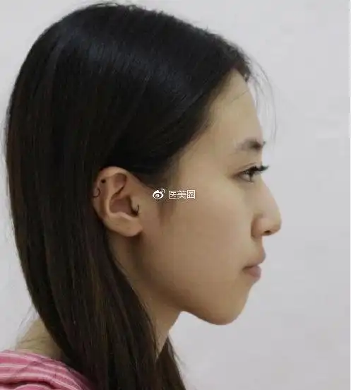 67手术前67看脸的社会,因为我鼻子有点驼峰鼻的赶脚,鼻翼也有点大