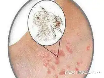 得了疥疮需要注意哪些