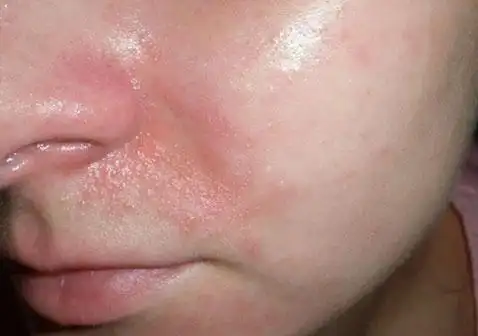 女性脸部脂溢性皮炎怎么治疗(女性脸部脂溢性皮炎怎么治疗好)