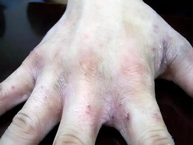 疥疮(传染性皮肤病)_石塘网