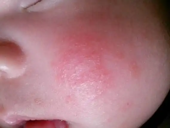 螨虫最大的天敌并不是暴晒:教你使个"笨"办法,螨虫"全都消失了"