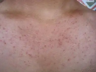 怎样治疗毛囊炎?