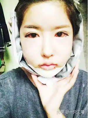 小姐姐在韩国的轮廓整形术前术后对比图分享