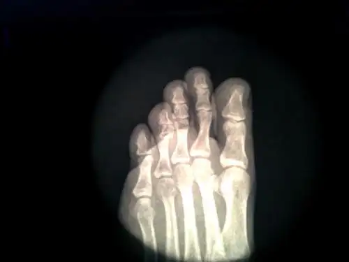 左足第四趾近节趾骨头骨折,长时间依然没有完全复位,该如何治疗,恢复