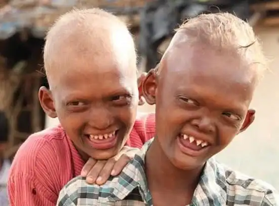 印度兄弟俩满嘴尖牙一头黄毛被称鬼男孩,没人和他们玩遭同学排斥