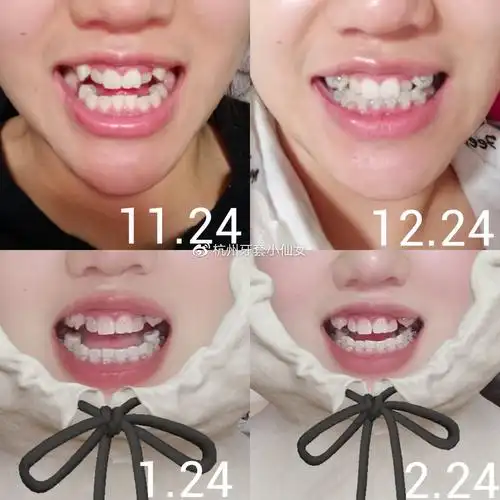 广州正畸07龅牙74嘴凸