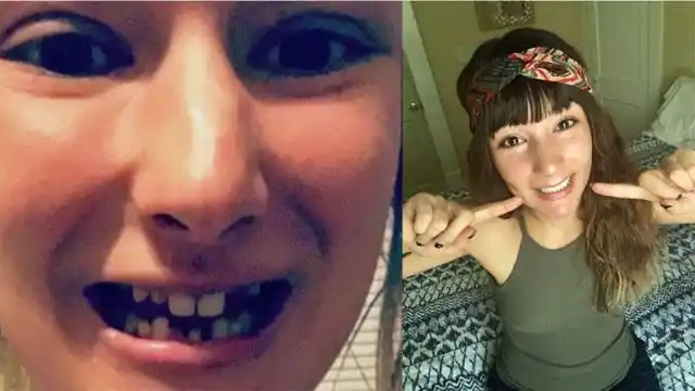 女子天生长着一副鲨鱼牙齿自卑了10年都不敢笑如今解脱