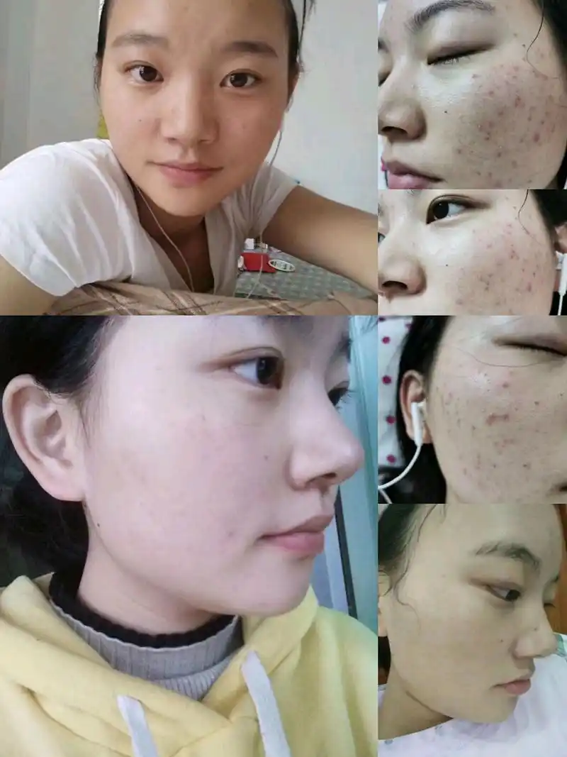 倪馨鑫–痘痘陪伴的岁月