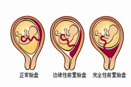 试管婴儿胎盘低流血怎么办