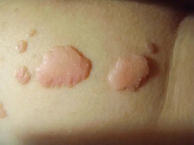 你的情况是疣   指导意见:   现在仅从图片上来看,是不能明确疣体的