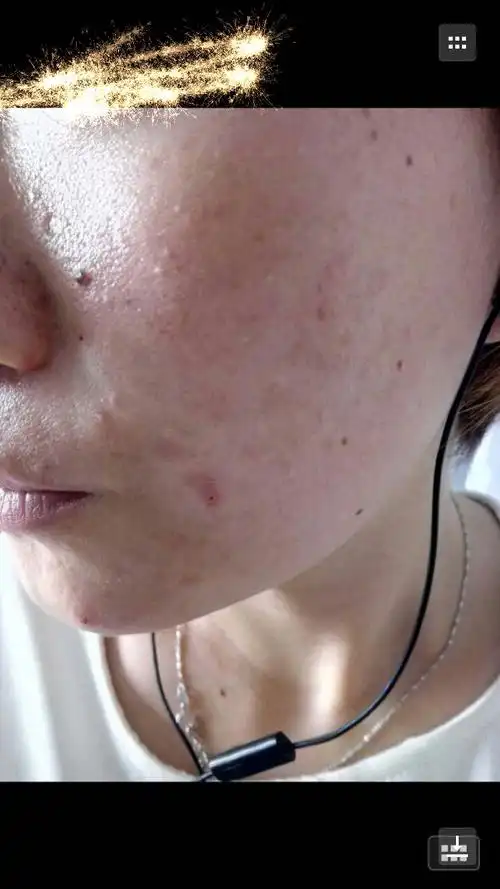 角质层薄只能慢慢来啦