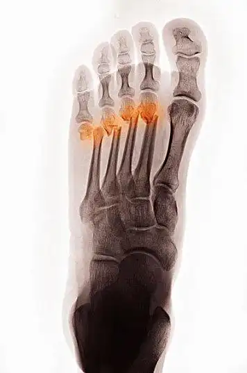 x光,脚,骨折_高清图片_全景视觉