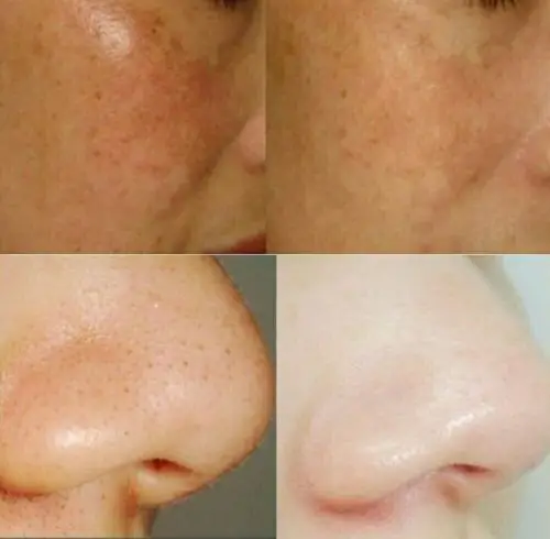 皮肤科美容项目介绍--果酸换肤术