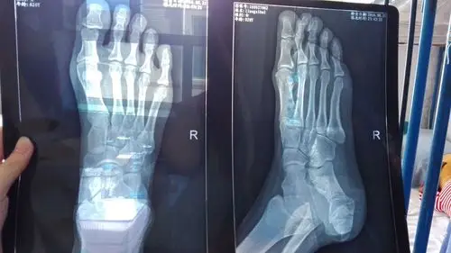 昨晚不小心从楼梯滑倒了,右脚扭伤了,照过x光,疼痛位置一个在脚拇