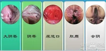 女性尖锐湿疣症状是怎样的长在什么部位,不手术用什么药能祛除-精准抗