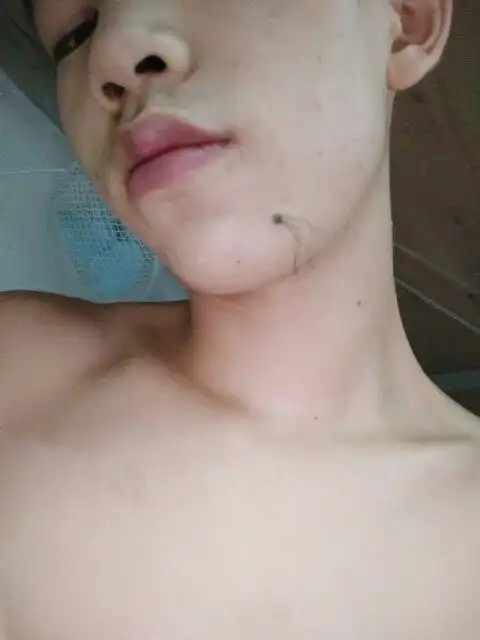 痣上长毛能剪掉吗